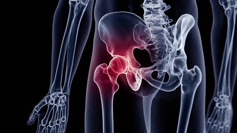 3d rendered medically accurate animation of a painful hip