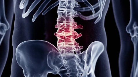 3d rendered medically accurate animation of a painful lumbar spine
