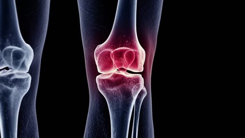3d rendered medically accurate animation of a painful knee