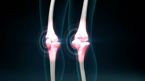 Arthritis of pain Knee. Healthy joint and unhealthy painful joint with osteoarthritis. 4k animation.1.