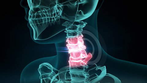 3d rendered illustration of a painful neck joint. medical concept, 4k animation.