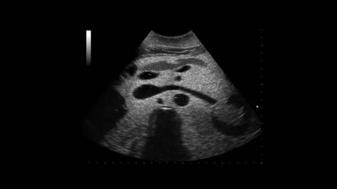Focused assessment with sonography aortic Aneurysm
