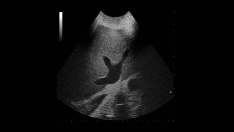 Morrison’s pouch:  Focused assessment with sonography
for abdominal trauma -
free liquid in right upper quadrant 
