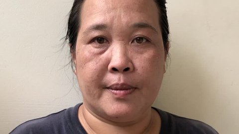 Asian woman 40s,check her skin problem of face, she as melasma freckles due to pigment melanin malfunction due to hormones,has under eye dark circles,Glabellar lines,Eye wrinkles.Selective focus.