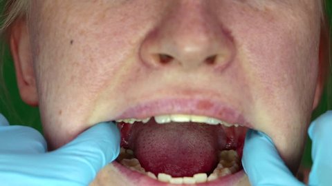 A woman with stomatitis on her cheek. Consequences after the removal of wisdom teeth. Macro cheek and wound on her. Seams on the gums are seen close-up. 