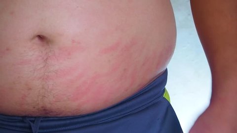 a fat man scratching the belly with hand. red spots on skin, allergies, psoriasis, insect bite. sunburn. 