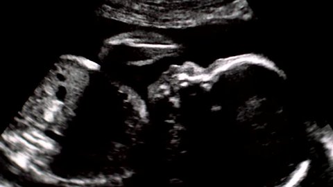 Footage of ultrasonography of second trimester pregnancy.