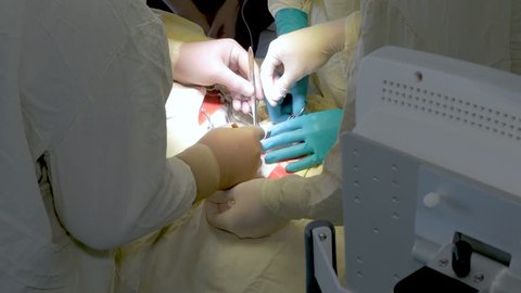 skilled surgeon assisted by specialists undergoes complicated surgery removing clot from carotid artery with devices