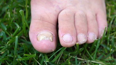 Fungal infection of the nails on the legs of an elderly person close-up.