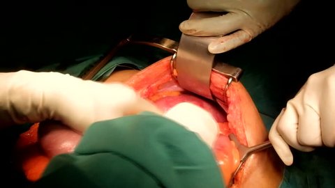 4K Footage of Exposing the Left sided Colon Carcinoma during Surgery.