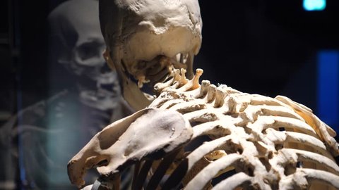 Human Skeleton With Spinal Disease: Arthritis, Osteoarthrosis, Osteoporosis, Degenerative Disc Disease, Curvature, Scoliosis
