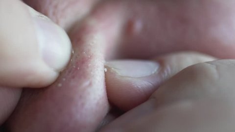 Face cleaning. A man squeezes black dots on his nose. Macro photography of acne, black dots and pores. He presses his fingers on his nose and white acne crawls out of his nose.