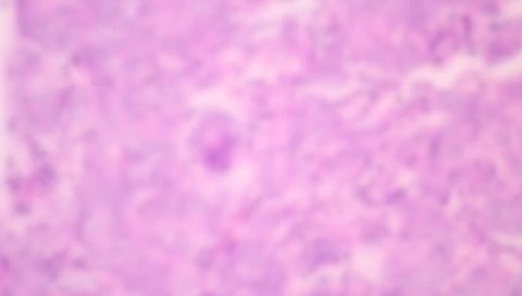 View in microscopic of ductal cell carcinoma, adenonocarcinoma from human breast cancer, tissue section by H and E stain.Pathology diagnosis.Medical concept. Under microscope, magnification 600X