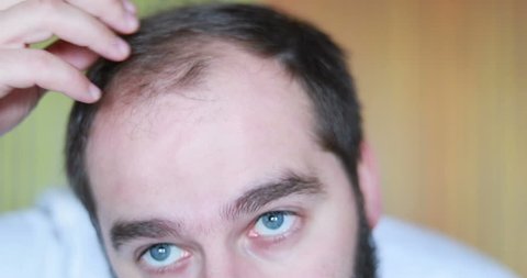 Bearded man standing in front of mirror and looking at his thinning hair, bald. 4k. portrait. Slow motion