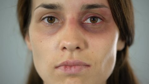 Woman with bruise on face sadly looking at camera, victim of assault in family