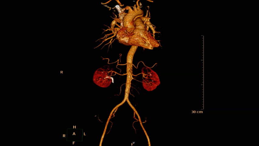 CTA-WHOLE-AORTA Footage, Videos and Clips in HD and 4K - Avopix.com