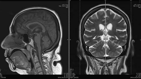 MRI of the brain sagittal and coronal plane,  T1 ,T2