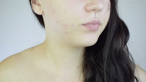 Brunette girl applies acne cream on face. Her cheeks are covered with red acne. Red rash. Close up HD