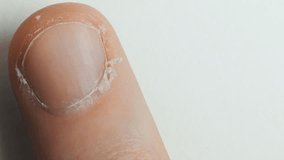 unattended nail and cuticle, bad nail grooming
