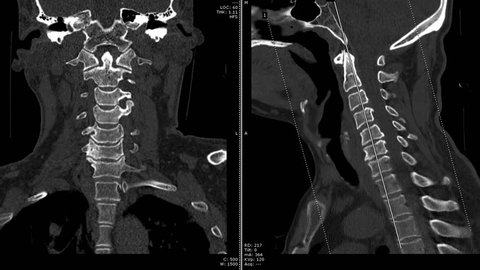 CT SCAN of Cervical Spine ( C-spine ) patient trauma case , Coronal and sagittal view with 3D rendering image . Medical technology concept.