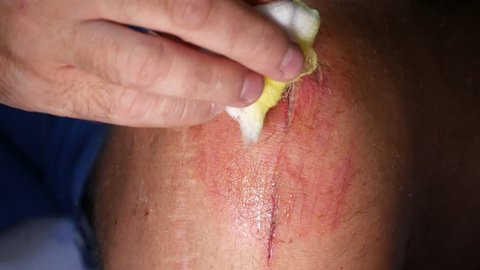 Man Taking Care of His Leg Wound Using Bandage and Antibiotics