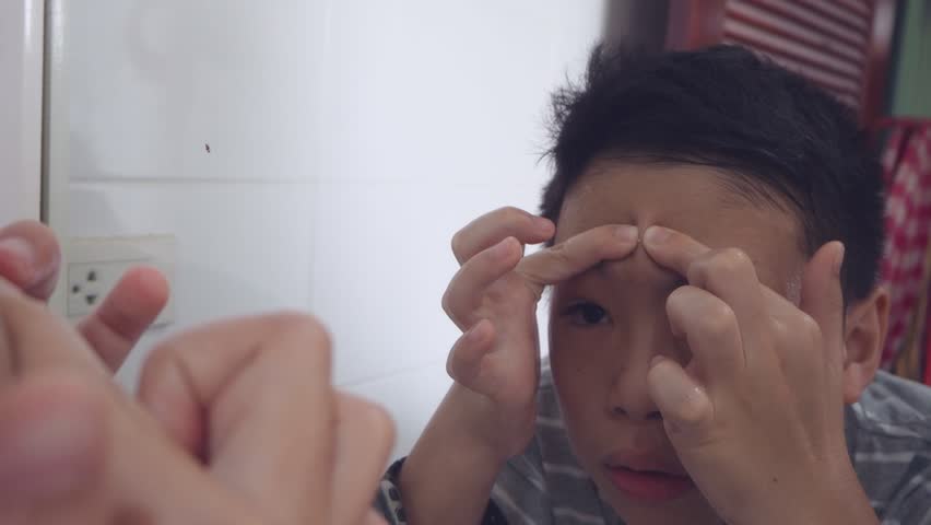 Teenager boy squeeze his acne on forehead in front of mirror