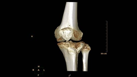 CT Scan of right knee  3d rendering image  rotating on the screen and 2D sagittal view with knee slab showing fracture tibia bone.