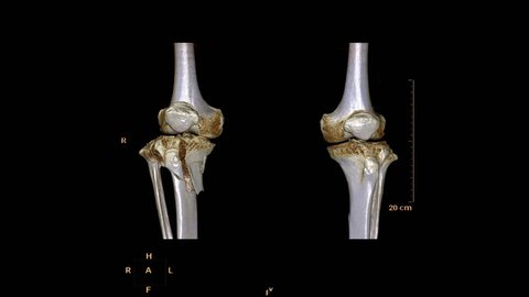 CT Scan of right knee  3d rendering image  rotating on the screen . Medical technology Concept.