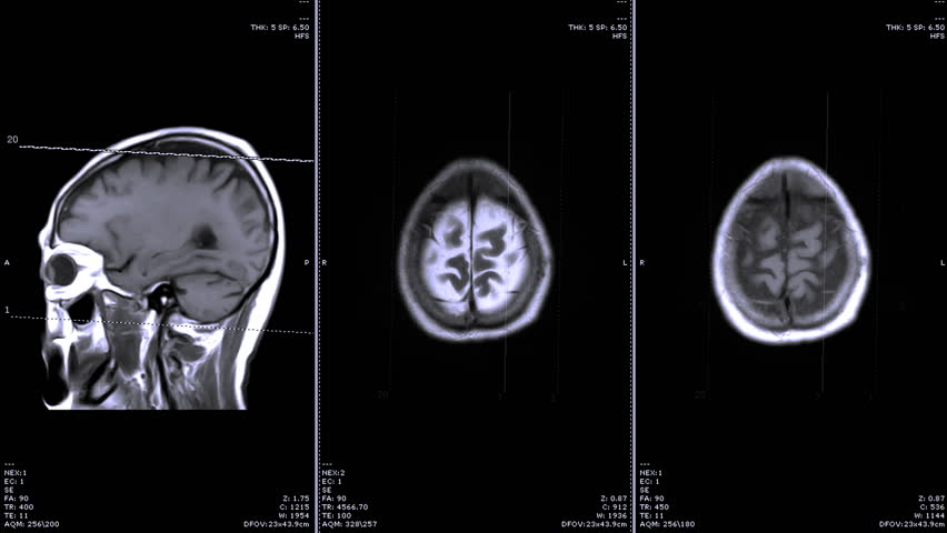 Comparison of MRI  brain sagittal and Axial plane for detect stroke and covid-19. Royalty-Free Stock Footage #1018476514