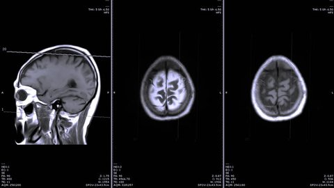 Comparison of MRI  brain sagittal and Axial plane for detect stroke and covid-19.