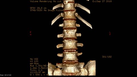 CT scan image of lumbar spine  3D rendering image Rotating on monitor . Medical technology concept.