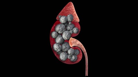 kidney with growing stones and depositet with alpha mask