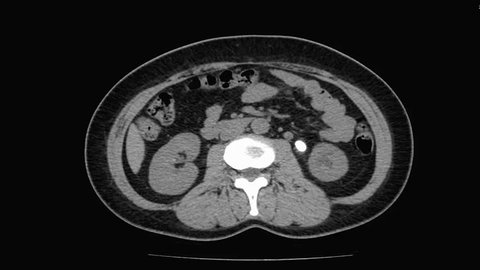 CT Scan of Kidney ureter bladder ( KUB ) System  Axial view for stone screening.