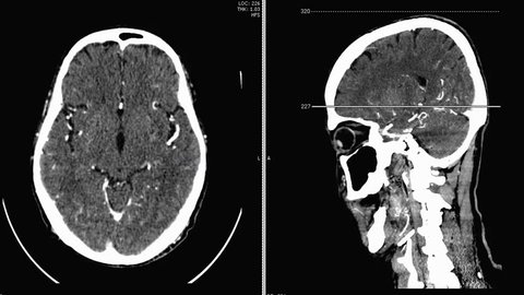 
CT SCAN angiography of the brain with contrast media , Axial and sagittal View , 3D rendering image.

