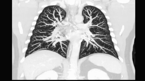 CT Chest or CT Scan of  Lung f Coronal MIP View for diagnosis TB,tuberculosis and coronavirus or covid-19 .
