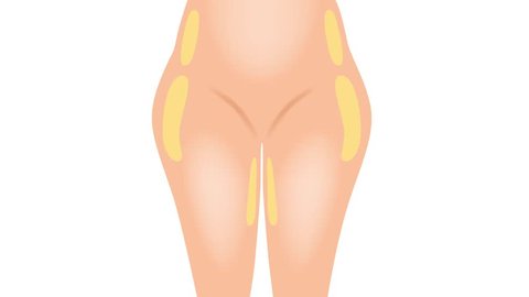Liposuction before and after , fat , cosmetic . step of Liposuction graphic animation / hip