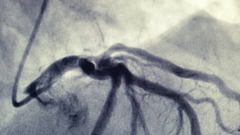 Coronary artery angiogram of left coronary artery during cardiac catheterization . Catheterization. Cardiac ventriculography is a medical imaging test used to determine a patient cardiac function 