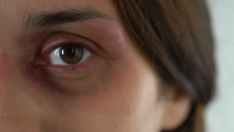 Bruised sad woman eye, terrified face of domestic violence victim close-up