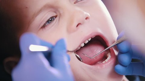 Dentistry. Dentist examines baby teeth. Close up
