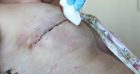 Bandaging of drained patient after breast surgery