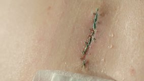 Close up video of scar after removal of surgical sutures. Large nevus has been excised surgically with a scalpel. Preventive measure against skin cancer.