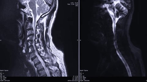 MRI of cervical spine and MRI myelogram on sagittal plane with spinal cord.