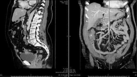 CT scan / CT whole abdomen with contrast media  sagittal plane vs coronal  plane . Appendicitis Concept.