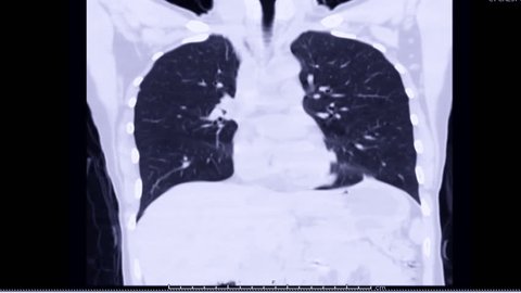 CT Chest Lung window Coronal view.