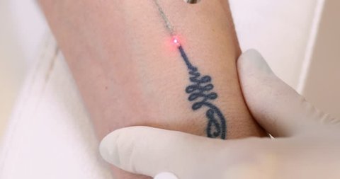 Close-up of laser tattoo removal from woman hand.