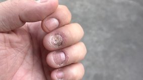 The man scratches his nail fungus. Fungal infection on nails hand, finger with onychomycosis, damage on human hand. Very itchy fingers, psoriasis.4k video footage.