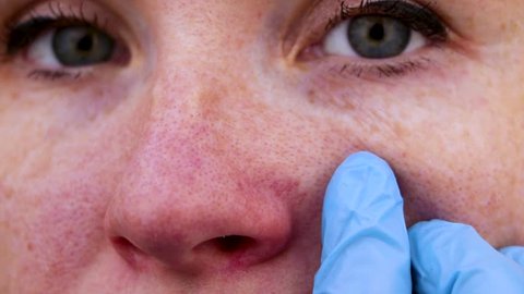Couperose on the nose of a young attractive girl. Capillary mesh treatment concept