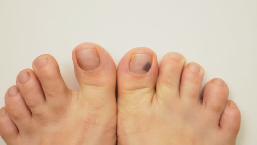 Toe Looks Bruised Under Nail - Nail Ftempo