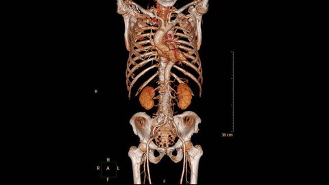 CTA ABDOMINAL AORTA Findings Abdominal aortic aneurysm ( AAA ) 3D rendering image.