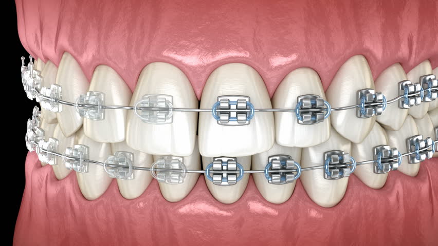 Teeth with Metal and Clear Stock Footage Video (100% Royalty-free ...